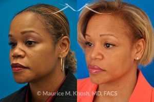 Photo of a patient before and after a procedure. Saddle Nose