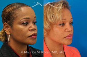 Photo of a patient before and after a procedure. Saddle Nose