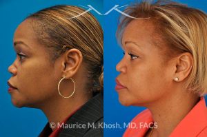 Photo of a patient before and after a procedure. Saddle Nose