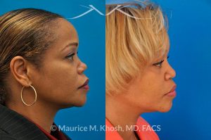 Photo of a patient before and after a procedure. Saddle Nose