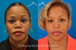 Photo of a patient before and after a procedure. Saddle Nose