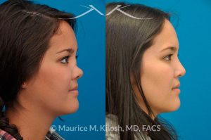 Photo of a patient before and after a procedure. Saddle Nose