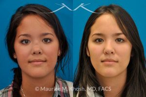 Photo of a patient before and after a procedure. Saddle Nose