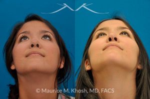 Photo of a patient before and after a procedure. Saddle Nose