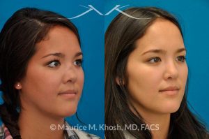 Photo of a patient before and after a procedure. Saddle Nose