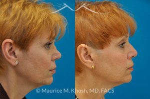 Photo of a patient before and after a procedure. Saddle Nose