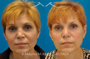 Photo of a patient before and after a procedure. Saddle Nose