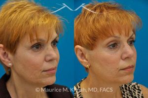 Photo of a patient before and after a procedure. Saddle Nose