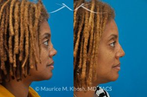 Photo of a patient before and after a procedure. Saddle Nose