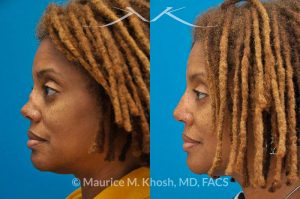 Photo of a patient before and after a procedure. Saddle Nose