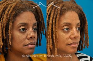 Photo of a patient before and after a procedure. Saddle Nose