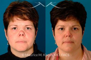 before and after photo taken after cosmetic procedure