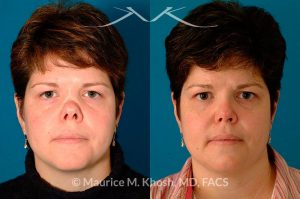 Photo of a patient before and after a procedure. Saddle Nose