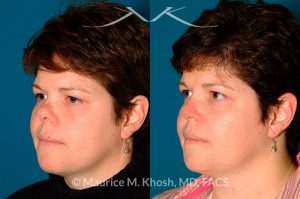 Photo of a patient before and after a procedure. Saddle Nose