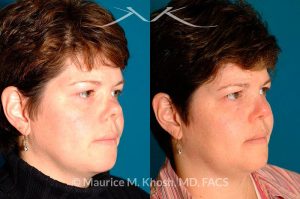 Photo of a patient before and after a procedure. Saddle Nose