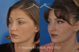 Photo of a patient before and after a procedure. Saddle nose - 27 year old with saddle nose collapse due to an autoimmune condition. She was bothered by the unnatural sag of the bridge of the nose, loss of nasal tip definition, and nasal obstruction. Her own rib cartilage was used during saddle nose rhinoplasty, to reconstruct the nose and restore breathing. The last two images show the computer simulation of surgical outcome (middle picture), as well as the final outcome (the picture on the right side). Patient is delighted with her results. 