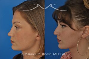 Photo of a patient before and after a procedure. Saddle nose - 27 year old with saddle nose collapse due to an autoimmune condition. She was bothered by the unnatural sag of the bridge of the nose, loss of nasal tip definition, and nasal obstruction. Her own rib cartilage was used during saddle nose rhinoplasty, to reconstruct the nose and restore breathing. The last two images show the computer simulation of surgical outcome (middle picture), as well as the final outcome (the picture on the right side). Patient is delighted with her results. 