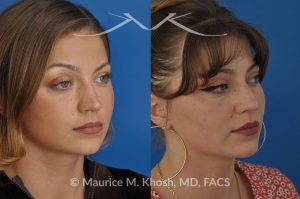 Photo of a patient before and after a procedure. Saddle nose - 27 year old with saddle nose collapse due to an autoimmune condition. She was bothered by the unnatural sag of the bridge of the nose, loss of nasal tip definition, and nasal obstruction. Her own rib cartilage was used during saddle nose rhinoplasty, to reconstruct the nose and restore breathing. The last two images show the computer simulation of surgical outcome (middle picture), as well as the final outcome (the picture on the right side). Patient is delighted with her results. 