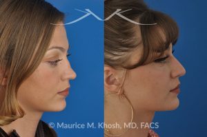 Photo of a patient before and after a procedure. Saddle nose - 27 year old with saddle nose collapse due to an autoimmune condition. She was bothered by the unnatural sag of the bridge of the nose, loss of nasal tip definition, and nasal obstruction. Her own rib cartilage was used during saddle nose rhinoplasty, to reconstruct the nose and restore breathing. The last two images show the computer simulation of surgical outcome (middle picture), as well as the final outcome (the picture on the right side). Patient is delighted with her results. 