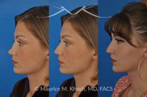 Photo of a patient before and after a procedure. Saddle nose - 27 year old with saddle nose collapse due to an autoimmune condition. She was bothered by the unnatural sag of the bridge of the nose, loss of nasal tip definition, and nasal obstruction. Her own rib cartilage was used during saddle nose rhinoplasty, to reconstruct the nose and restore breathing. The last two images show the computer simulation of surgical outcome (middle picture), as well as the final outcome (the picture on the right side). Patient is delighted with her results. 