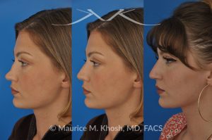 Photo of a patient before and after a procedure. Saddle nose - 27 year old with saddle nose collapse due to an autoimmune condition. She was bothered by the unnatural sag of the bridge of the nose, loss of nasal tip definition, and nasal obstruction. Her own rib cartilage was used during saddle nose rhinoplasty, to reconstruct the nose and restore breathing. The last two images show the computer simulation of surgical outcome (middle picture), as well as the final outcome (the picture on the right side). Patient is delighted with her results. 