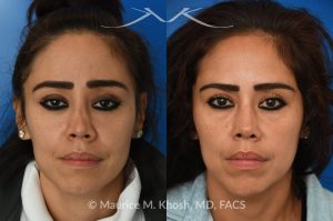 Photo of a patient before and after a procedure. Saddle Nose Rhinoplasty - This patient had previously undergone an unsuccessful rhinoplasty surgery with cadaver rib cartilage graft. She had developed a saddle collapse of her nose and loss of nasal tip definition. Her own rib and temporalis fascia was used to reconstruct the nose. She is ecstatic with her results at 6 months post op. 
