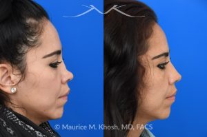 Photo of a patient before and after a procedure. Saddle Nose Rhinoplasty - This patient had previously undergone an unsuccessful rhinoplasty surgery with cadaver rib cartilage graft. She had developed a saddle collapse of her nose and loss of nasal tip definition. Her own rib and temporalis fascia was used to reconstruct the nose. She is ecstatic with her results at 6 months post op. 