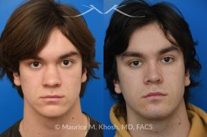 Photo of a patient before and after a procedure. Saddle Nose - Saddle nose collapse in this young patient was repaired with his own rib cartilage. Surgery not only improved his nasal deformity, it also enhanced his breathing capacity. 