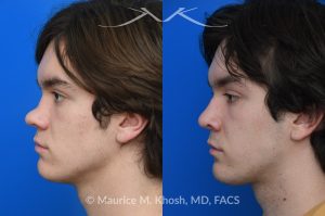 Photo of a patient before and after a procedure. Saddle Nose - Saddle nose collapse in this young patient was repaired with his own rib cartilage. Surgery not only improved his nasal deformity, it also enhanced his breathing capacity. 