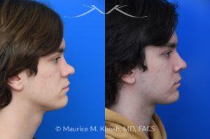 Photo of a patient before and after a procedure. Saddle Nose - Saddle nose collapse in this young patient was repaired with his own rib cartilage. Surgery not only improved his nasal deformity, it also enhanced his breathing capacity. 