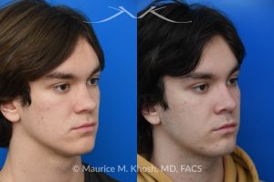Photo of a patient before and after a procedure. Saddle Nose - Saddle nose collapse in this young patient was repaired with his own rib cartilage. Surgery not only improved his nasal deformity, it also enhanced his breathing capacity. 