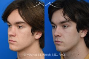 Photo of a patient before and after a procedure. Saddle Nose - Saddle nose collapse in this young patient was repaired with his own rib cartilage. Surgery not only improved his nasal deformity, it also enhanced his breathing capacity. 
