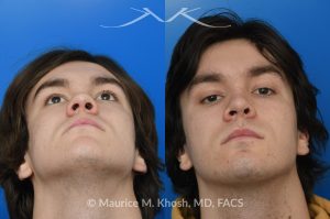 Photo of a patient before and after a procedure. Saddle Nose - Saddle nose collapse in this young patient was repaired with his own rib cartilage. Surgery not only improved his nasal deformity, it also enhanced his breathing capacity. 
