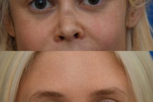 Photo of a patient before and after a procedure. Saddle Nose Repair with Autologous Rib Cartilage Graft 1  - Saddle nose deformity repair was performed to correct a collapsed nasal bridge, over-rotation of the nasal tip, and a deep crease across the lower bridge. The patient’s own rib cartilage was used to create two structural grafts—one along the dorsum and one supporting the tip (an L-strut configuration). A dermal graft was added to refine the dorsal contour and smooth the transition over the cartilage graft. Surgery effectively restored dorsal height, a straight and natural nasal profile, proper tip position and projection, and normal breathing function.  