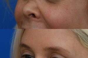 Photo of a patient before and after a procedure. Saddle Nose Repair with Autologous Rib Cartilage Graft 1  - Saddle nose deformity repair was performed to correct a collapsed nasal bridge, over-rotation of the nasal tip, and a deep crease across the lower bridge. The patient’s own rib cartilage was used to create two structural grafts—one along the dorsum and one supporting the tip (an L-strut configuration). A dermal graft was added to refine the dorsal contour and smooth the transition over the cartilage graft. Surgery effectively restored dorsal height, a straight and natural nasal profile, proper tip position and projection, and normal breathing function.  