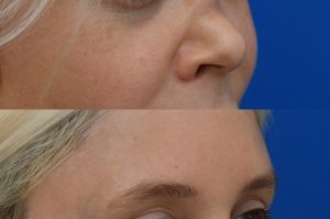 Photo of a patient before and after a procedure. Saddle Nose Repair with Autologous Rib Cartilage Graft 1  - Saddle nose deformity repair was performed to correct a collapsed nasal bridge, over-rotation of the nasal tip, and a deep crease across the lower bridge. The patient’s own rib cartilage was used to create two structural grafts—one along the dorsum and one supporting the tip (an L-strut configuration). A dermal graft was added to refine the dorsal contour and smooth the transition over the cartilage graft. Surgery effectively restored dorsal height, a straight and natural nasal profile, proper tip position and projection, and normal breathing function.  