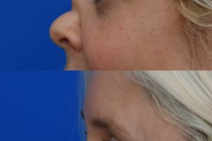 Photo of a patient before and after a procedure. Saddle Nose Repair with Autologous Rib Cartilage Graft 1  - Saddle nose deformity repair was performed to correct a collapsed nasal bridge, over-rotation of the nasal tip, and a deep crease across the lower bridge. The patient’s own rib cartilage was used to create two structural grafts—one along the dorsum and one supporting the tip (an L-strut configuration). A dermal graft was added to refine the dorsal contour and smooth the transition over the cartilage graft. Surgery effectively restored dorsal height, a straight and natural nasal profile, proper tip position and projection, and normal breathing function.  