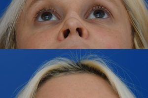 Photo of a patient before and after a procedure. Saddle Nose Repair with Autologous Rib Cartilage Graft 1  - Saddle nose deformity repair was performed to correct a collapsed nasal bridge, over-rotation of the nasal tip, and a deep crease across the lower bridge. The patient’s own rib cartilage was used to create two structural grafts—one along the dorsum and one supporting the tip (an L-strut configuration). A dermal graft was added to refine the dorsal contour and smooth the transition over the cartilage graft. Surgery effectively restored dorsal height, a straight and natural nasal profile, proper tip position and projection, and normal breathing function.  